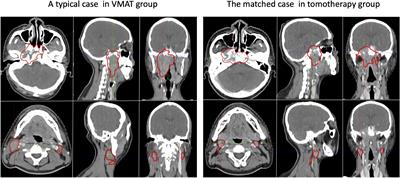 Volumetric modulated arc therapy versus tomotherapy for late T-stage nasopharyngeal carcinoma